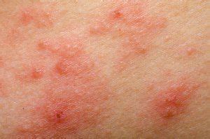 Allergy Rashes: Images, Symptoms, Treatment