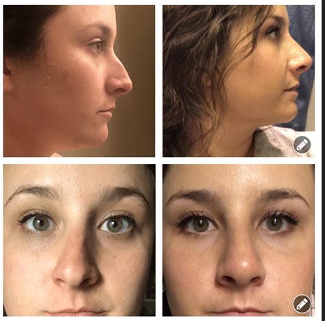 6 days post septorhinoplasty with turbinate reduction! | Scrolller