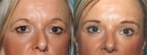 Brow Lift Before & Afters | Quaba Plastic Surgery Edinburgh