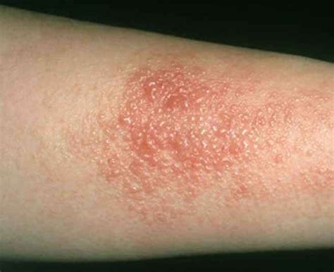 Contact Dermatitis & Allergic Rash Treatment Los Angeles, Skin Allergy Clinic Los Angeles ...