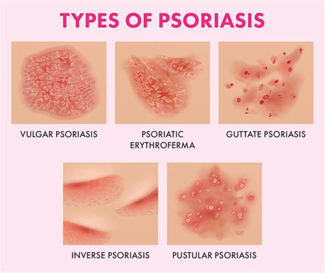 The Ultimate Guide To Psoriasis: What Causes It And How To Treat It | Blog | HUDA BEAUTY