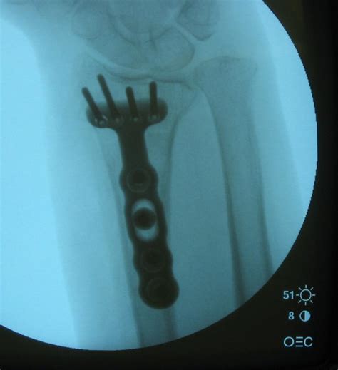 ORIF of Distal Radius Fractures : Wheeless' Textbook of Orthopaedics