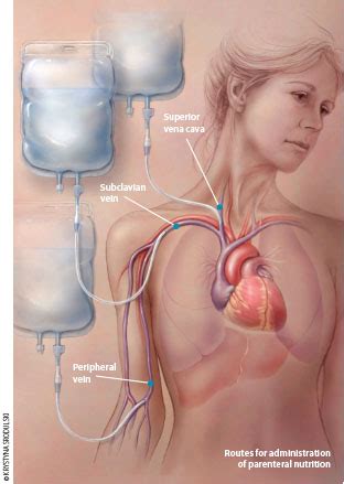 Benefits and risks of parenteral nutrition in patients with cancer ...