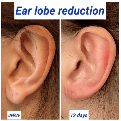 Earlobe Reduction Surgery | Ear Surgery - Harley Clinic