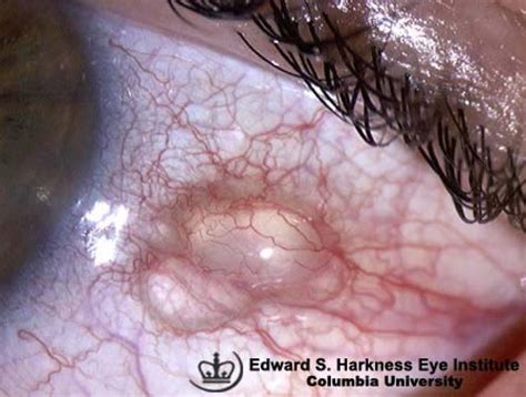 Conjunctival Cyst | Vagelos College of Physicians and Surgeons