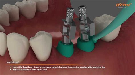 TSIII Fixture Placement & Impression taking (Pick-up and Transfer ...