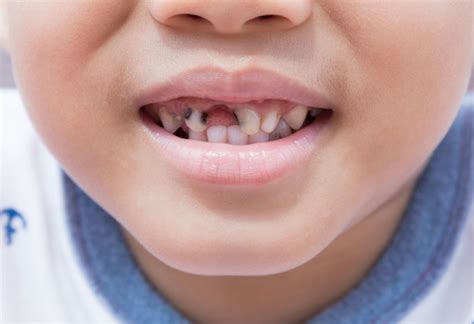 Rotten Teeth Kids Usually Experience: Causes and Treatment - LessConf