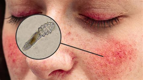 Do Demodex Mites Cause Rosacea? - OZIDEX