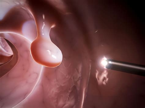 What Is a Polyp? | YourCareEverywhere