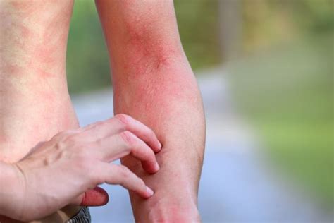 Fire Ant Bites: Treatment And Relief From The Itch - EFI