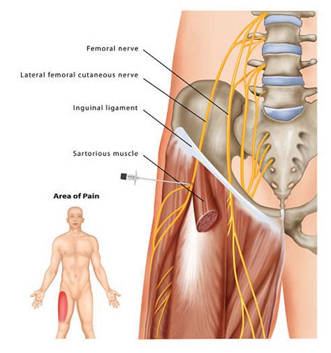 Lateral Femoral Cutaneous Nerve Block | Pain Treatment | Pain Spa, Bristol, UK