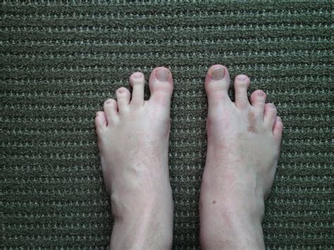 Recovery & scars from Morton's Neuroma Surgery | Chris Freeland | Flickr