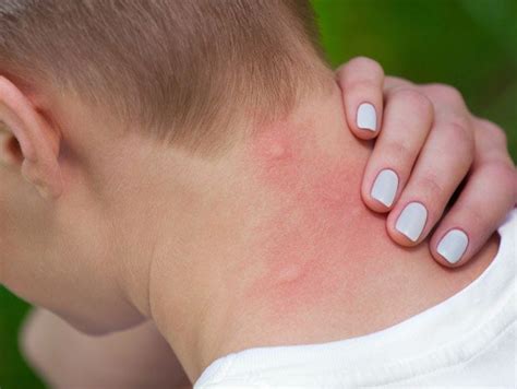 9 Bug Bite Pictures - How To Identify Common Types Of Bug Bites