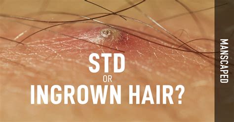 STD or Ingrown Hair? | Manscaped.com – MANSCAPED