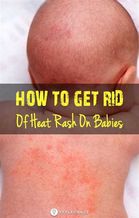 Baby heat rash – Artofit