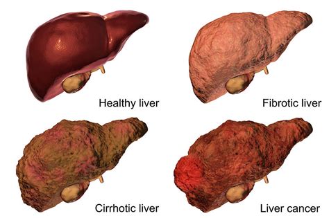 Stages Of Liver Disease Photograph By Kateryna Konsci - vrogue.co