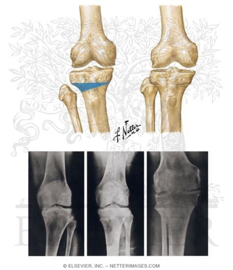 High Tibial Osteotomy for Varus Deformity of Knee