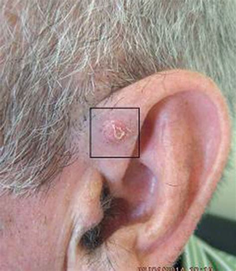 Squamous Cell Carcinoma Ear