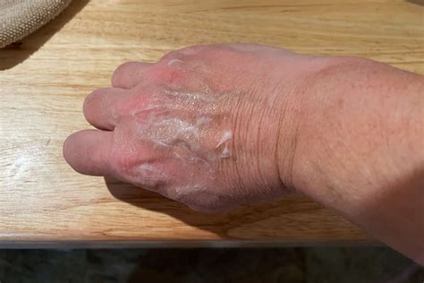 The 8 Best Eczema Creams of 2024