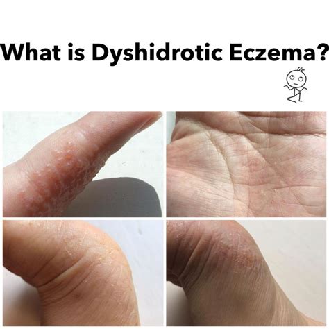 What is Dyshidrotic Eczema? Blisters on fingers, hands, and feet. #WartsRemedies #eczemalotions ...