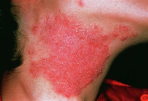 Evelyn Lawson Headline: Skin Fungus Types