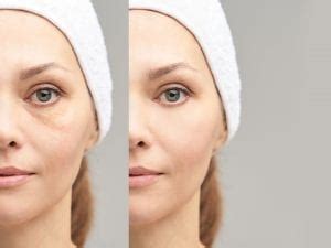 Thermage vs Ultherapy | Thermage and Ultherapy near me London, Buckinghamshire | The Cosmetic ...