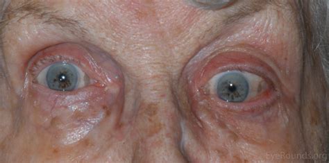 Adenoid cystic carcinoma of the lacrimal gland