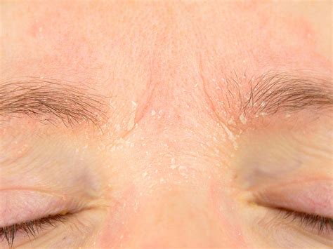 Eyebrow dandruff: Causes, treatments, and remedies