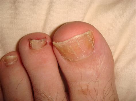 Dry Skin On My Toe Nail