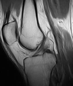 Diagnosis of anterior cruciate ligament injury (ACL) | Bayside Standing MRI