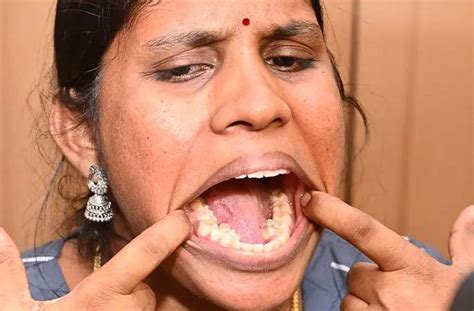 Indian woman sets world record with most teeth