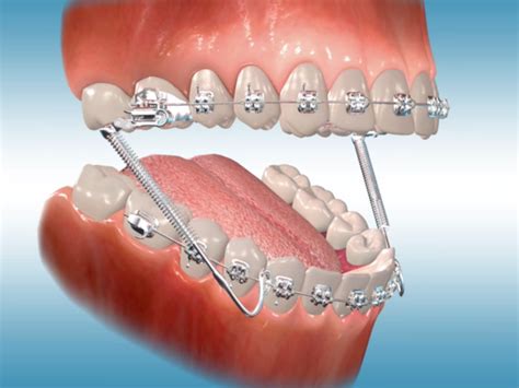 How Do Archwires Move Teeth at Charles Everhart blog