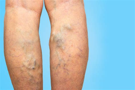 Are Varicose Veins Worse Than Spider Veins?