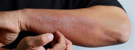 Winter Eczema: How to Prevent Flare-Ups | The Dermatology Center Of Indiana