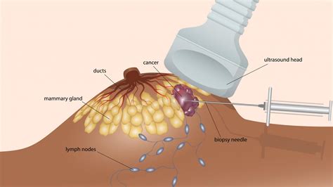 Ultrasound scans | Irish Cancer Society