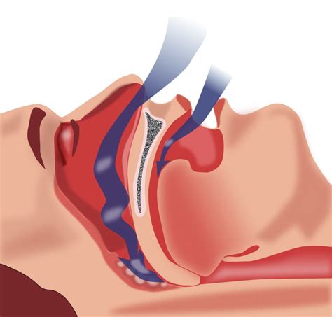 Sleep apnea – diagnosis and causes of the sleep disorder – New Bedford Guide