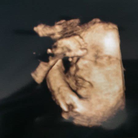 3D ultrasound with anterior placenta? - BabyCenter