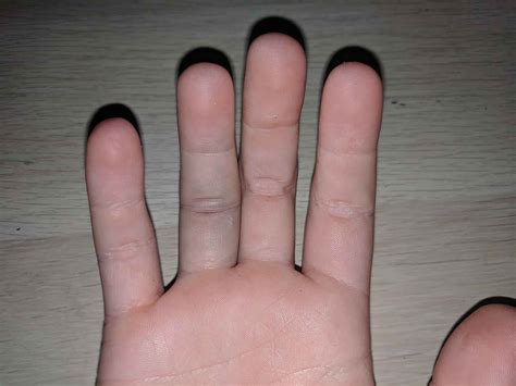 Jammed finger causes, symptoms & jammed finger treatment