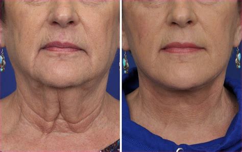 Neck Lift Before And After Photos | Printable Templates Free
