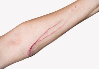 What to Do if You Are Scratched by a Cat | Preventive Vet