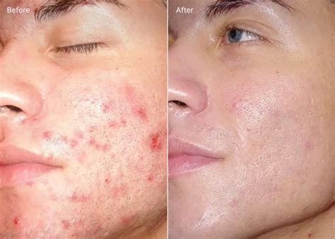 Microdermabrasion Blackheads Before And After