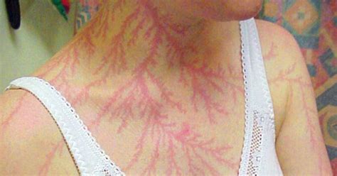 Lichtenberg Scars — Nature’s Tattoo You Don’t Want To Have | Lightning photography, Lightning ...