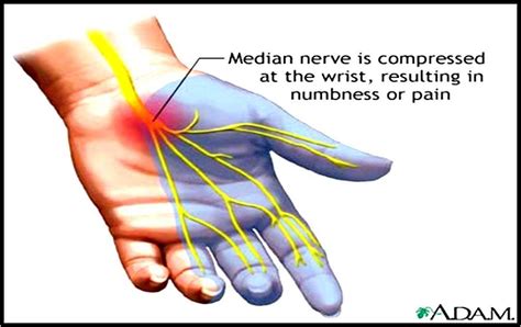 Carpal tunnel syndrome