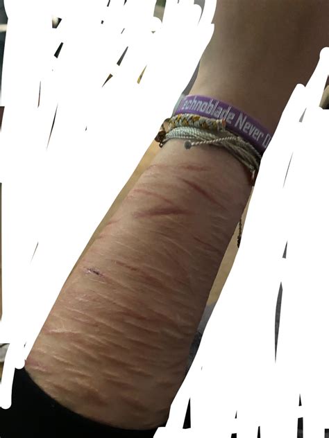 lol 4 months boiled water scar 🤡🤡🤡 I think it will stay with me for the ...