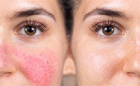 Facial Redness Treatment: You Need To Know About Rosacea