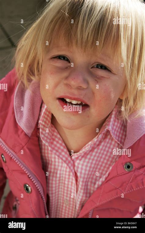 Little girl with skin disease Stock Photo - Alamy