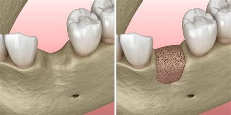 Bone & Soft Tissue Grafting | Alfano Oral & Maxillofacial Surgery | Enola