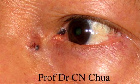 Eyelid Surgery by Prof Dr CN CHUA 蔡鐘能: Common Presentations of Eyelid Cancers - the Straight ...
