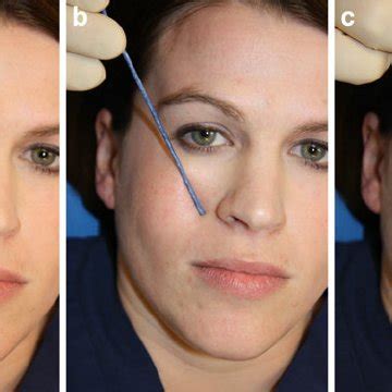 Infraorbital Nerve Block Complications