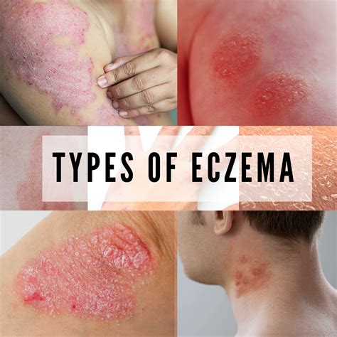 Eczema Causes In Adults at Etta Wilson blog